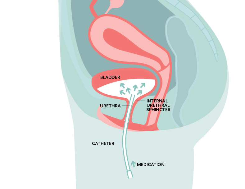 Antibiotic bladder instillation for Interstitial Cystitis Treatment