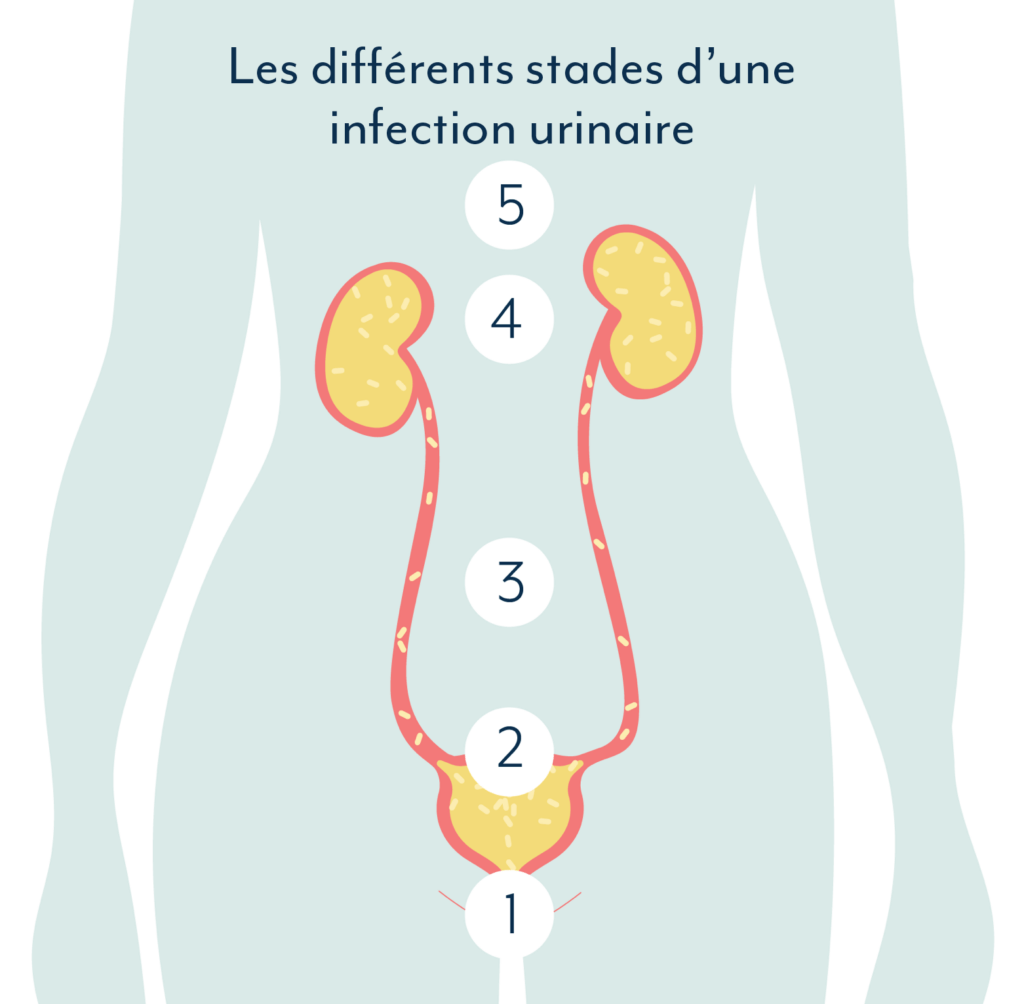 infection urinaire et grossesse : les différents stades d'une infection urinaire