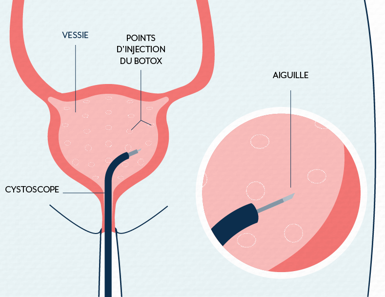 Le botox aide la vessie à lutter contre l'incontinence urinaire et les infections urinaires