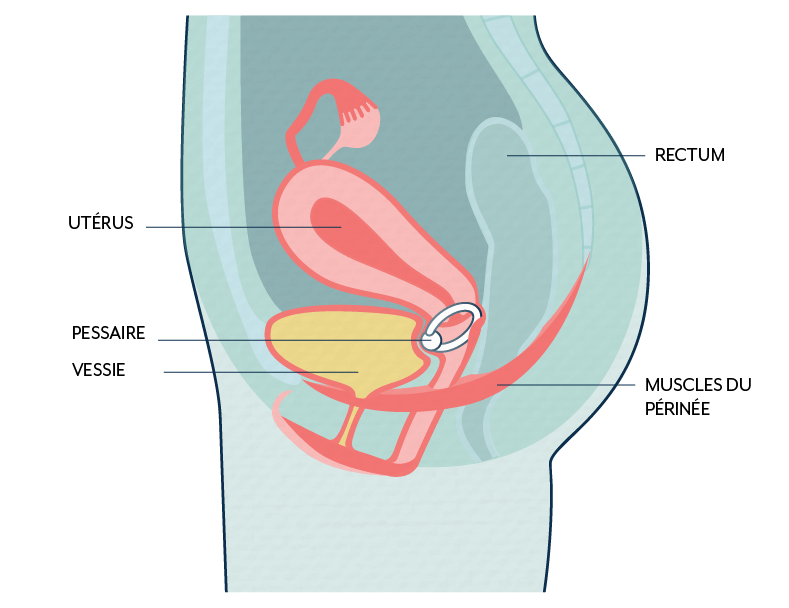 Pessaire pour lutter contre l'incontinence urinaire et les infections urinaires