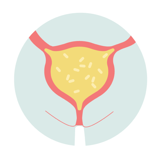 Chronic Urinary Tract Infection - UTI Pathway Step 1