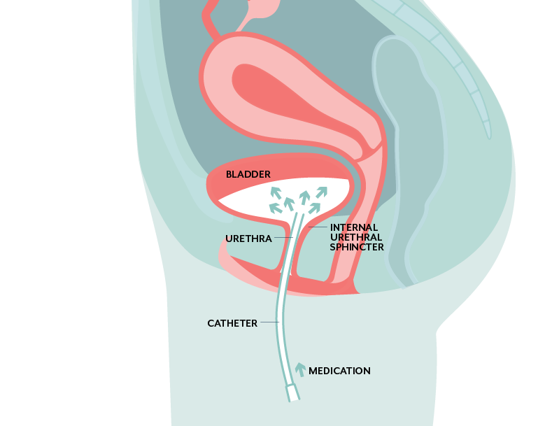 Antibiotic bladder instillations - Interstitial Cystitis Treatment Interstitial Cystitis Treatment - antibiotic bladder instillation