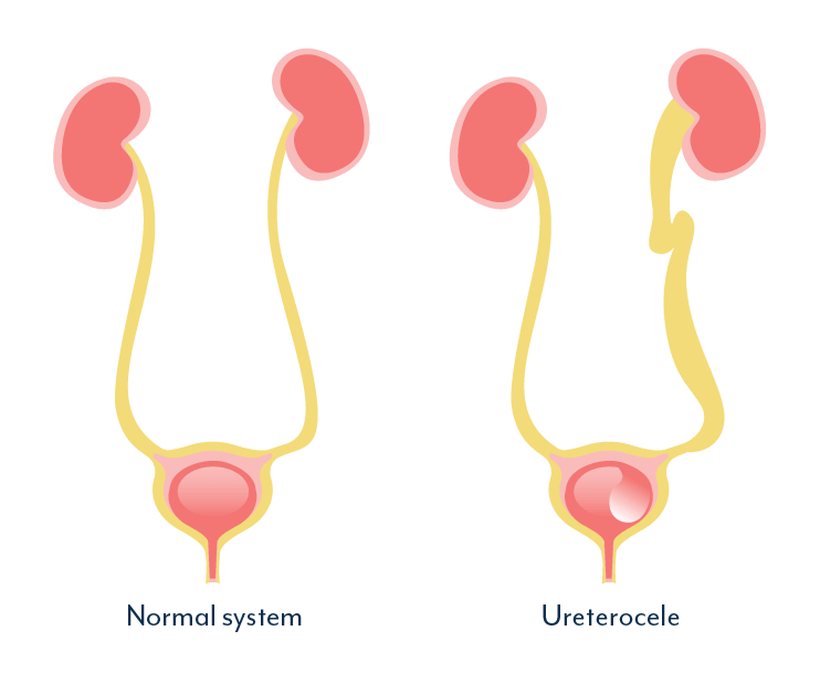 Muscles of the pelvis prolapse