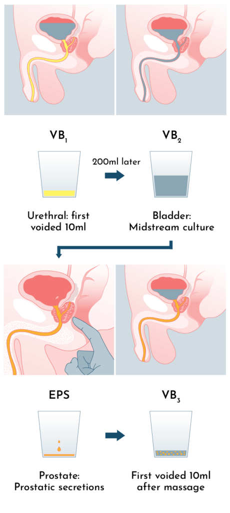 Four glass test for male UTI treatment