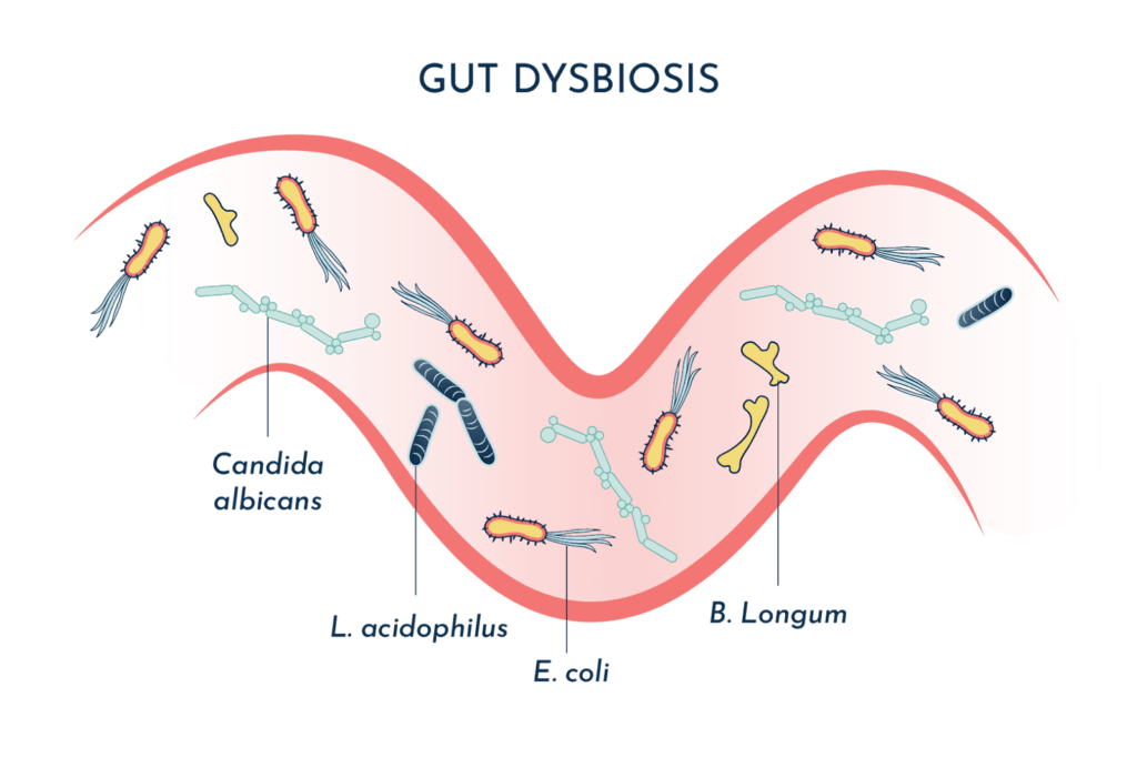 Gut dysbiosis