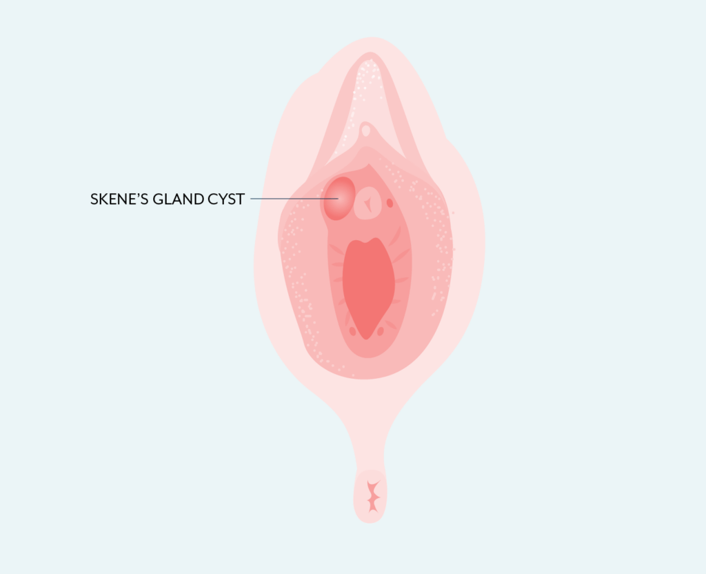 Skene's gland cyst