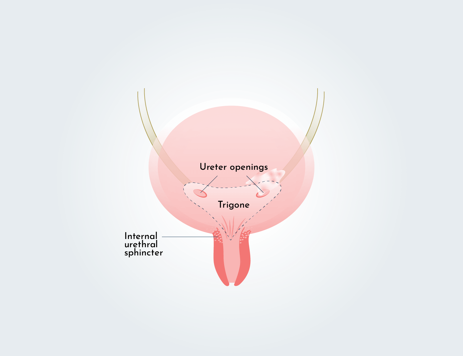 Fulguration for trigonitis and UTI