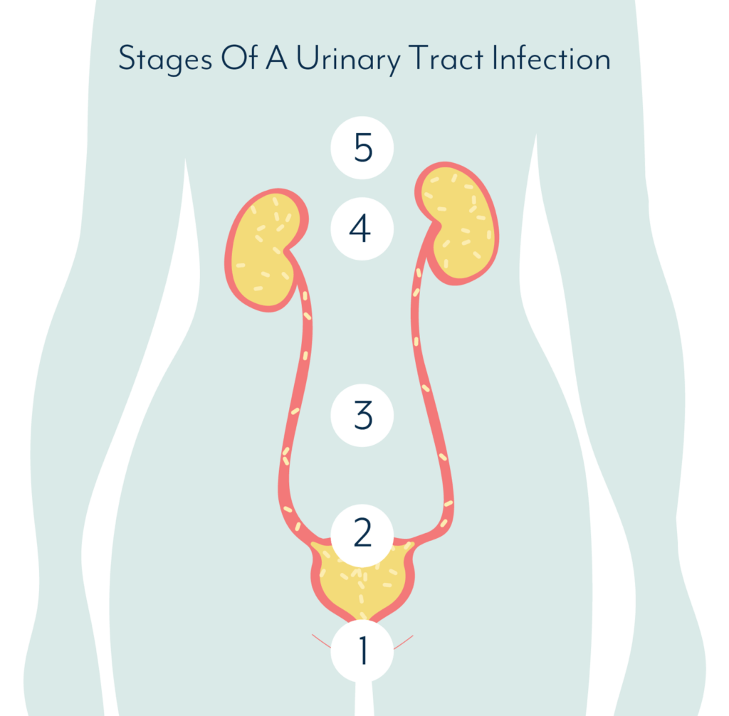 Stages of a UTI